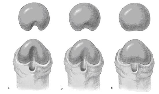 Hypospadias Surgery