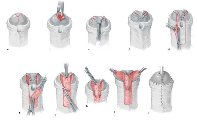 hypospadias repair procedure